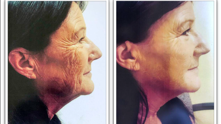 Our Non-Invasive Face Lifts Also Vanish Wrinkles And Produce Dramatically Youthful Transformations