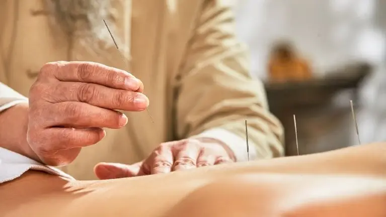Accupuncture