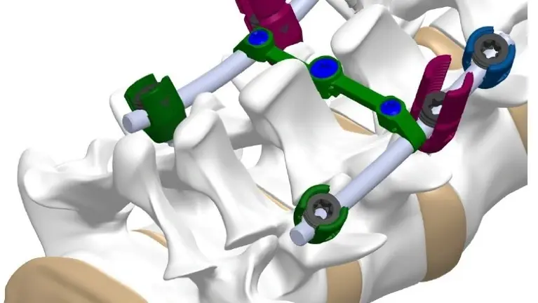 Spinal Implant Technology and QMS